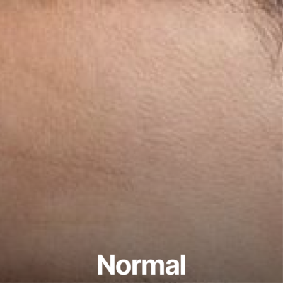Normal